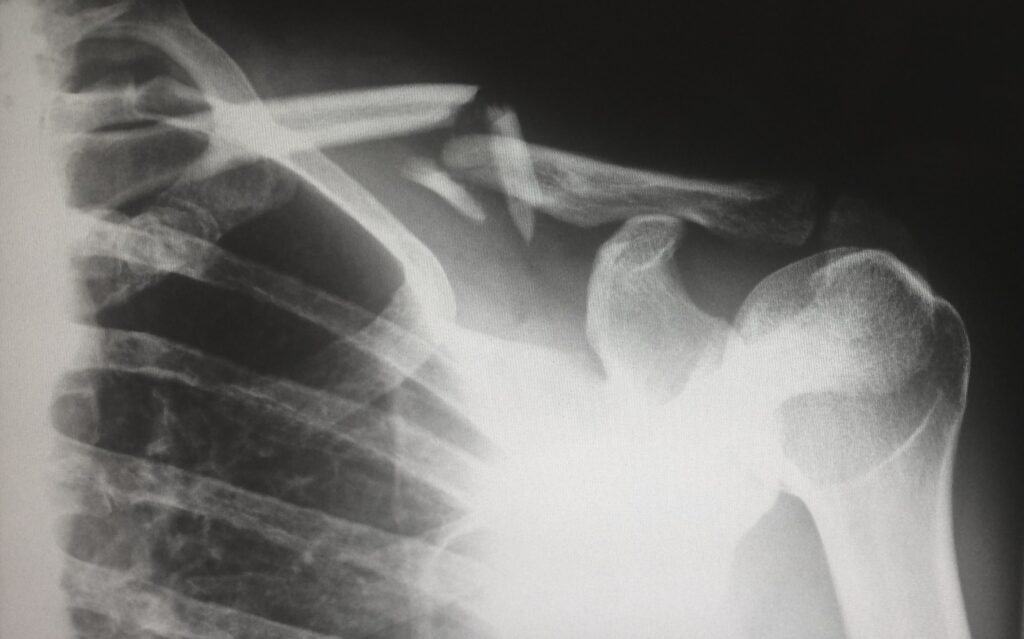 Xray showing a broken collar bone